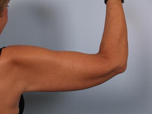 Brachioplasty (Arm Lift) After Photo | Phoenix and Scottsdale, AZ | Scottsdale Center for Plastic Surgery