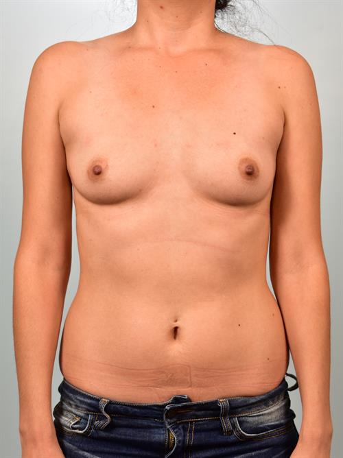 Breast Augmentation Before Photo | Phoenix and Scottsdale, AZ | Scottsdale Center for Plastic Surgery