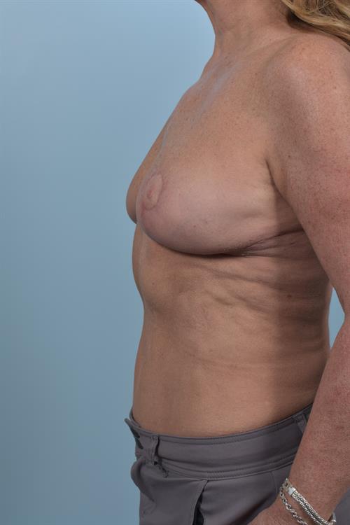 Breast Lift (Mastopexy) After Photo | Phoenix and Scottsdale, AZ | Scottsdale Center for Plastic Surgery