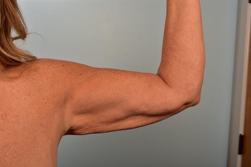 Brachioplasty (Arm Lift) Before Photo | Phoenix and Scottsdale, AZ | Scottsdale Center for Plastic Surgery