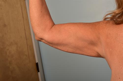 Brachioplasty (Arm Lift) Before Photo | Phoenix and Scottsdale, AZ | Scottsdale Center for Plastic Surgery