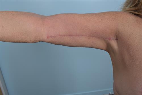 Brachioplasty (Arm Lift) After Photo | Phoenix and Scottsdale, AZ | Scottsdale Center for Plastic Surgery