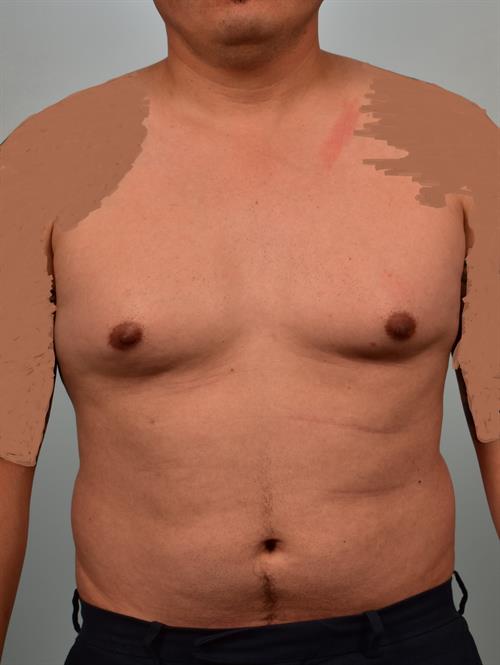 Male Liposuction Before Photo | Phoenix and Scottsdale, AZ | Scottsdale Center for Plastic Surgery