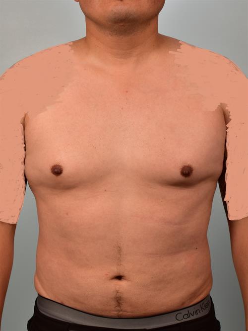 Male Liposuction After Photo | Phoenix and Scottsdale, AZ | Scottsdale Center for Plastic Surgery