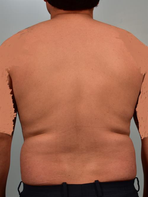 Male Breast/Areola Reduction Before Photo | Phoenix and Scottsdale, AZ | Scottsdale Center for Plastic Surgery