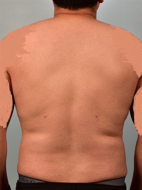 Male Breast/Areola Reduction After Photo | Phoenix and Scottsdale, AZ | Scottsdale Center for Plastic Surgery