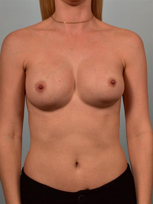 Sub-Fascial Breast Augmentation Before Photo | Phoenix and Scottsdale, AZ | Scottsdale Center for Plastic Surgery