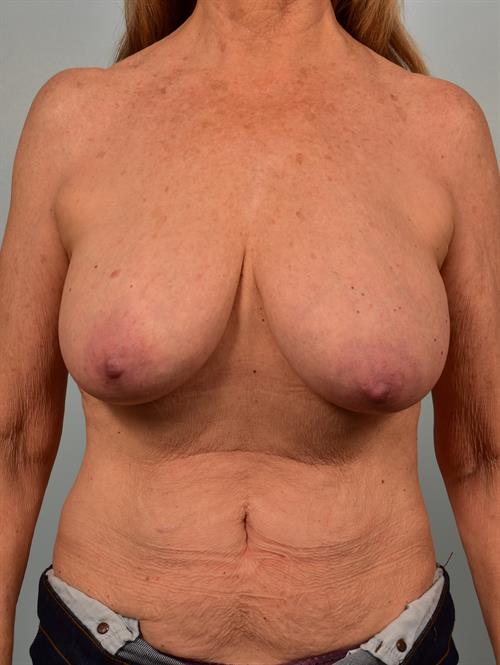 Breast Reduction Before Photo | Phoenix and Scottsdale, AZ | Scottsdale Center for Plastic Surgery