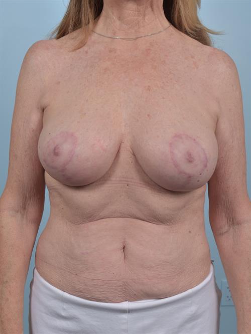 Breast Reduction After Photo | Phoenix and Scottsdale, AZ | Scottsdale Center for Plastic Surgery