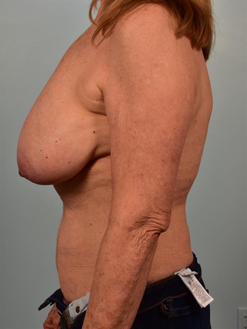 Breast Reduction Before Photo | Phoenix and Scottsdale, AZ | Scottsdale Center for Plastic Surgery