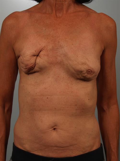 Breast Augmentation Before Photo | Paradise Valley, AZ | Scottsdale Center for Plastic Surgery