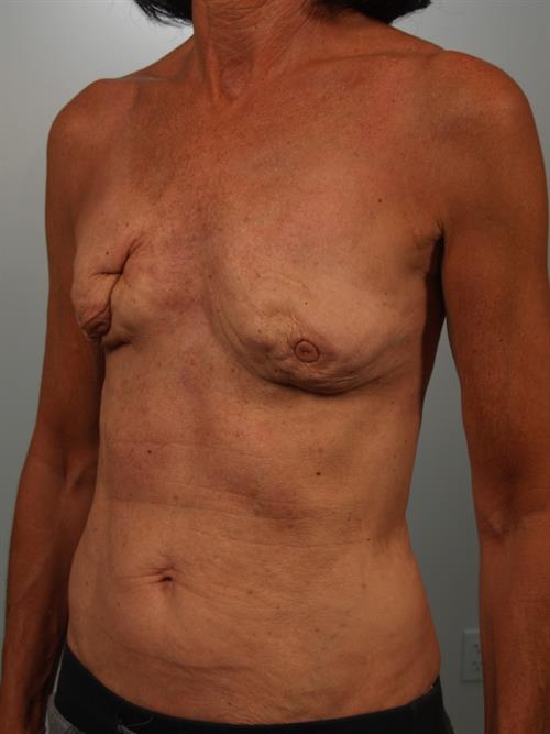 Revision Breast Surgery Before Photo | Phoenix and Scottsdale, AZ | Scottsdale Center for Plastic Surgery