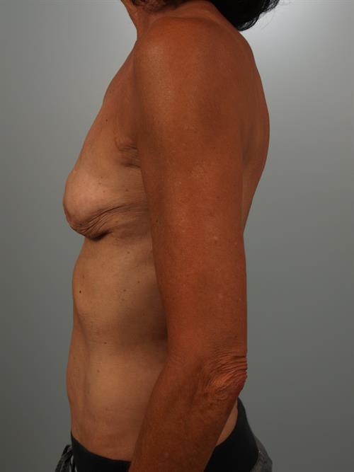 Revision Breast Surgery Before Photo | Phoenix and Scottsdale, AZ | Scottsdale Center for Plastic Surgery