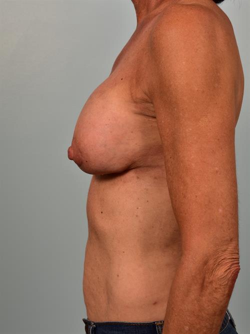 Sub-Fascial Breast Augmentation After Photo | ,  | 