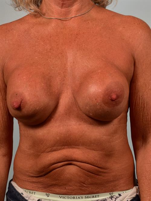 Revision Breast Surgery Before Photo | Phoenix and Scottsdale, AZ | Scottsdale Center for Plastic Surgery