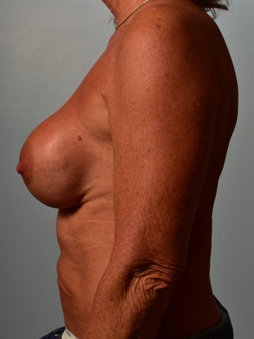 Revision Breast Surgery Before Photo | Phoenix and Scottsdale, AZ | Scottsdale Center for Plastic Surgery