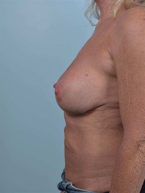 Revision Breast Surgery After Photo | Phoenix and Scottsdale, AZ | Scottsdale Center for Plastic Surgery