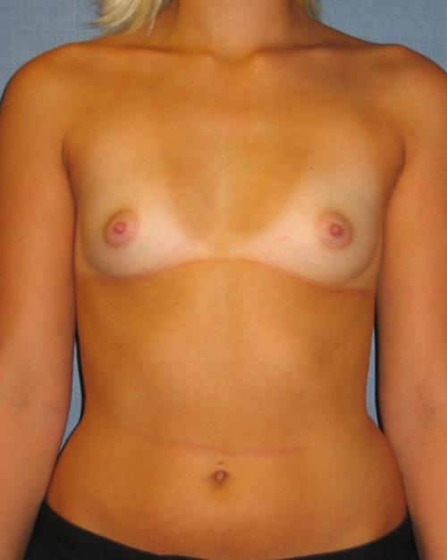 Breast Augmentation Before Photo | Phoenix and Scottsdale, AZ | Scottsdale Center for Plastic Surgery