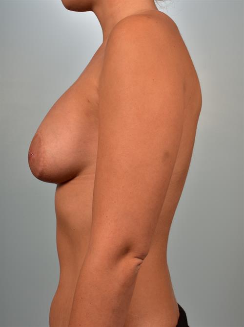 Revision Breast Surgery Before Photo | Phoenix and Scottsdale, AZ | Scottsdale Center for Plastic Surgery