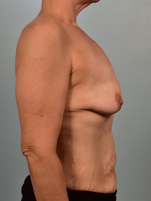 Breast Augmentation Before Photo | Phoenix and Scottsdale, AZ | Scottsdale Center for Plastic Surgery