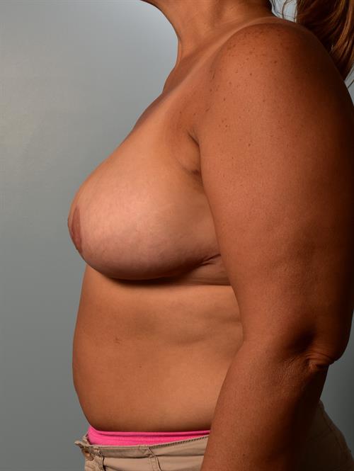 Breast Lift (Mastopexy) After Photo | Phoenix and Scottsdale, AZ | Scottsdale Center for Plastic Surgery