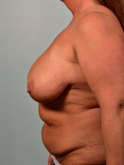 Fat Grafting Before Photo | , |