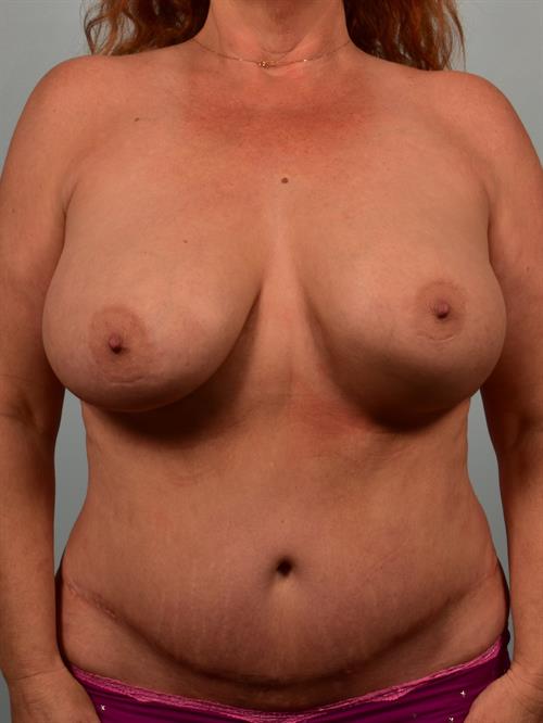 Breast Lift (Mastopexy) with Implants Before Photo | Phoenix and Scottsdale, AZ | Scottsdale Center for Plastic Surgery