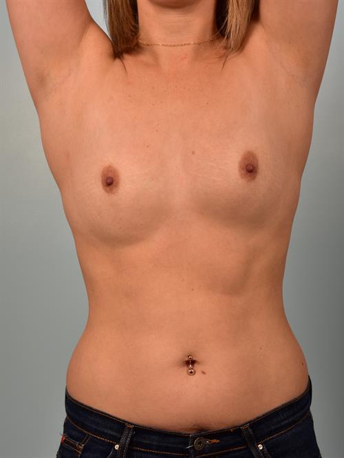 Breast Augmentation Before Photo | Phoenix and Scottsdale, AZ | Scottsdale Center for Plastic Surgery