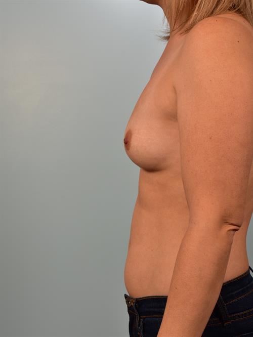 Breast Augmentation Before Photo | Phoenix and Scottsdale, AZ | Scottsdale Center for Plastic Surgery