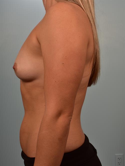 Breast Augmentation Before Photo | Phoenix and Scottsdale, AZ | Scottsdale Center for Plastic Surgery