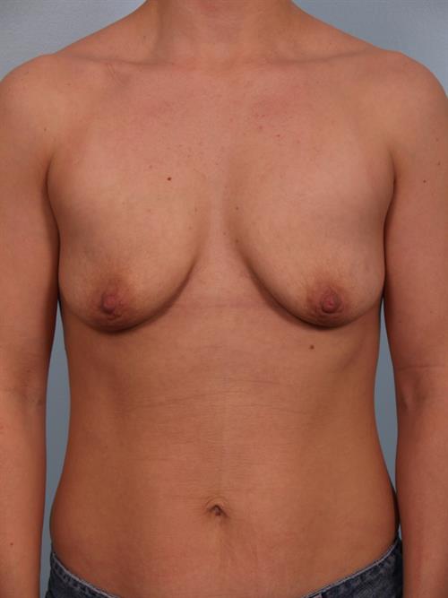 Breast Augmentation Before Photo | Phoenix and Scottsdale, AZ | Scottsdale Center for Plastic Surgery