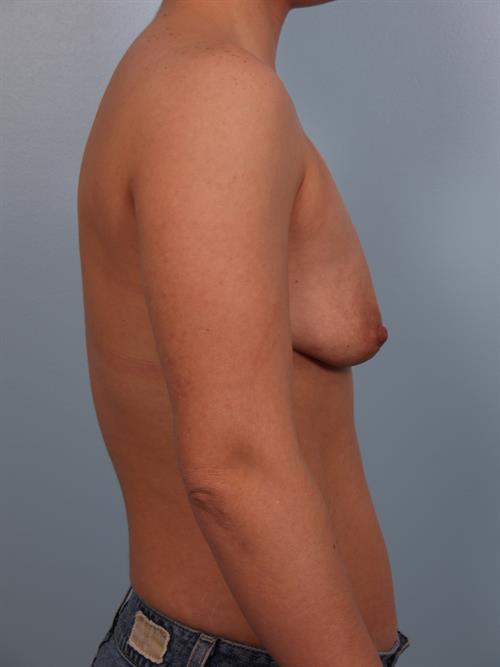 Breast Augmentation Before Photo | Phoenix and Scottsdale, AZ | Scottsdale Center for Plastic Surgery