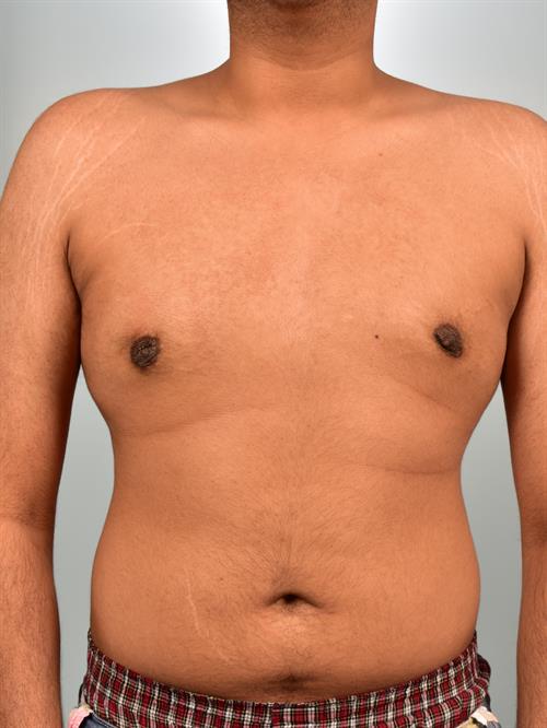 Male Breast/Areola Reduction After Photo | Phoenix and Scottsdale, AZ | Scottsdale Center for Plastic Surgery