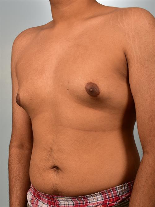 Male Breast/Areola Reduction Before Photo | Phoenix and Scottsdale, AZ | Scottsdale Center for Plastic Surgery