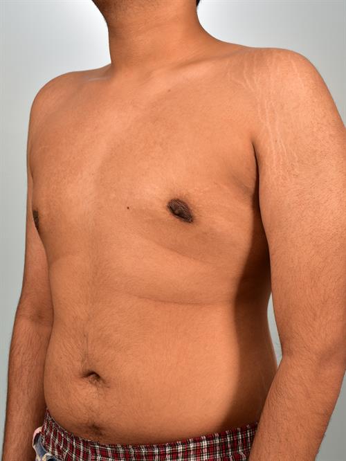 Male Breast/Areola Reduction After Photo | Phoenix and Scottsdale, AZ | Scottsdale Center for Plastic Surgery