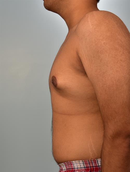 Male Breast/Areola Reduction Before Photo | Phoenix and Scottsdale, AZ | Scottsdale Center for Plastic Surgery