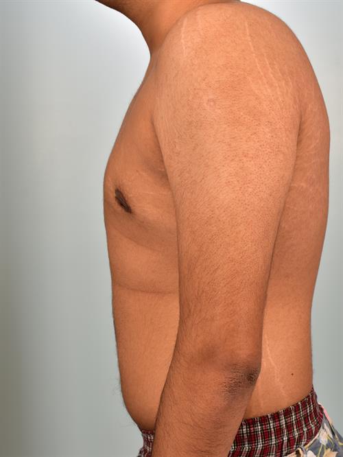 Male Breast/Areola Reduction After Photo | Phoenix and Scottsdale, AZ | Scottsdale Center for Plastic Surgery