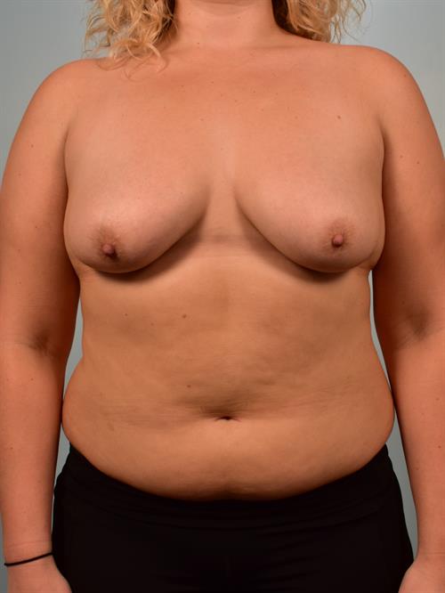 Breast Lift (Mastopexy) with Implants Before Photo | Phoenix and Scottsdale, AZ | Scottsdale Center for Plastic Surgery
