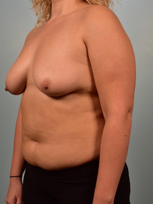 Breast Lift (Mastopexy) with Implants Before Photo | Phoenix and Scottsdale, AZ | Scottsdale Center for Plastic Surgery