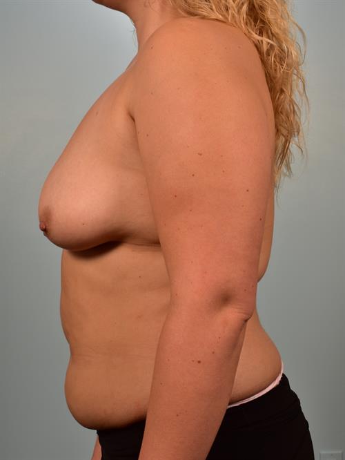 Breast Lift (Mastopexy) with Implants Before Photo | ,  | 