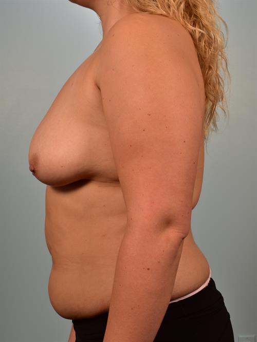 Breast Lift (Mastopexy) with Implants Before Photo | Phoenix and Scottsdale, AZ | Scottsdale Center for Plastic Surgery