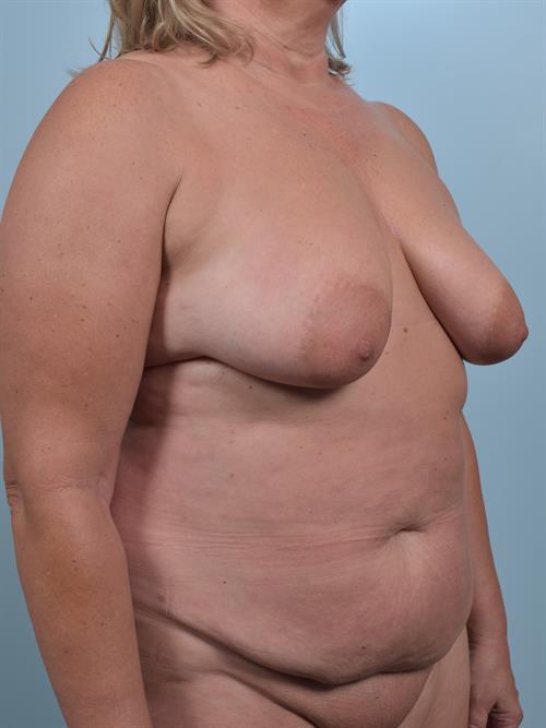 Sub-Fascial Breast Augmentation Before Photo | Phoenix and Scottsdale, AZ | Scottsdale Center for Plastic Surgery