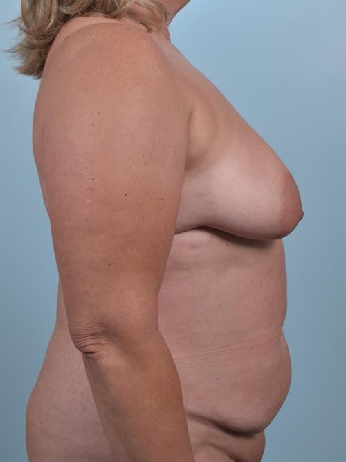 Sub-Fascial Breast Augmentation Before Photo | Phoenix and Scottsdale, AZ | Scottsdale Center for Plastic Surgery