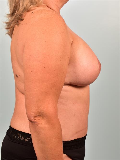 Sub-Fascial Breast Augmentation After Photo | Phoenix and Scottsdale, AZ | Scottsdale Center for Plastic Surgery