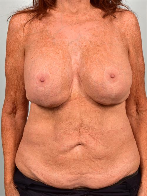 Fat Grafting Before Photo | , |
