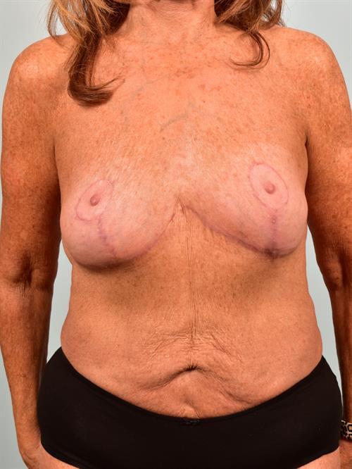 Breast Implant Removal After Photo | ,  | 