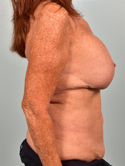 Fat Grafting Before Photo | , |