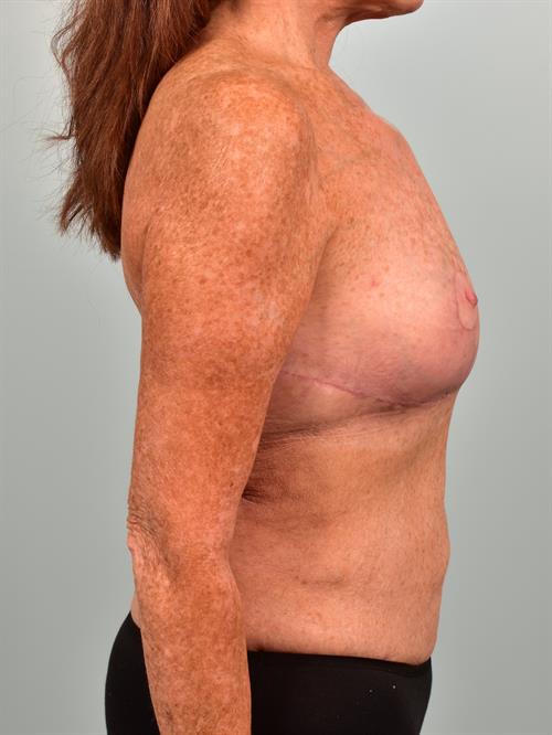 Fat Grafting After Photo | , |