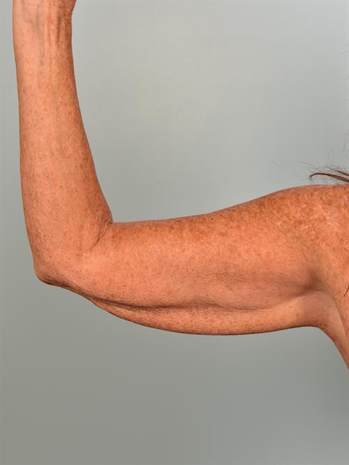Brachioplasty (Arm Lift) Before Photo | Phoenix and Scottsdale, AZ | Scottsdale Center for Plastic Surgery