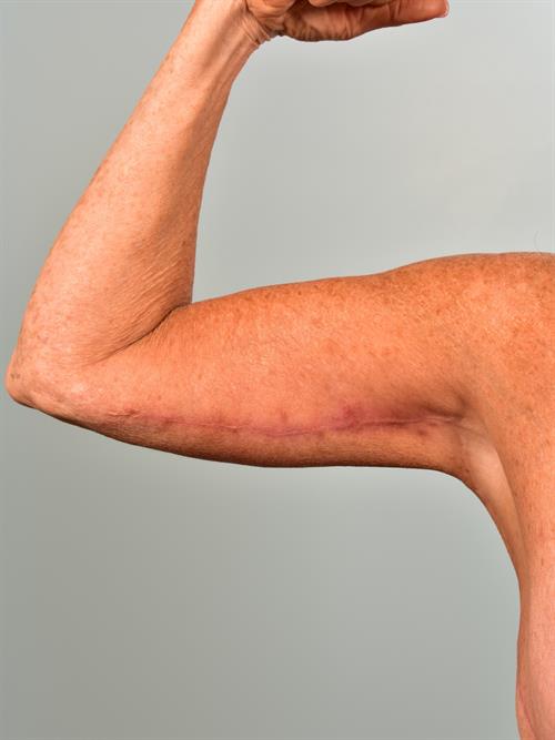Brachioplasty (Arm Lift) After Photo | Phoenix and Scottsdale, AZ | Scottsdale Center for Plastic Surgery